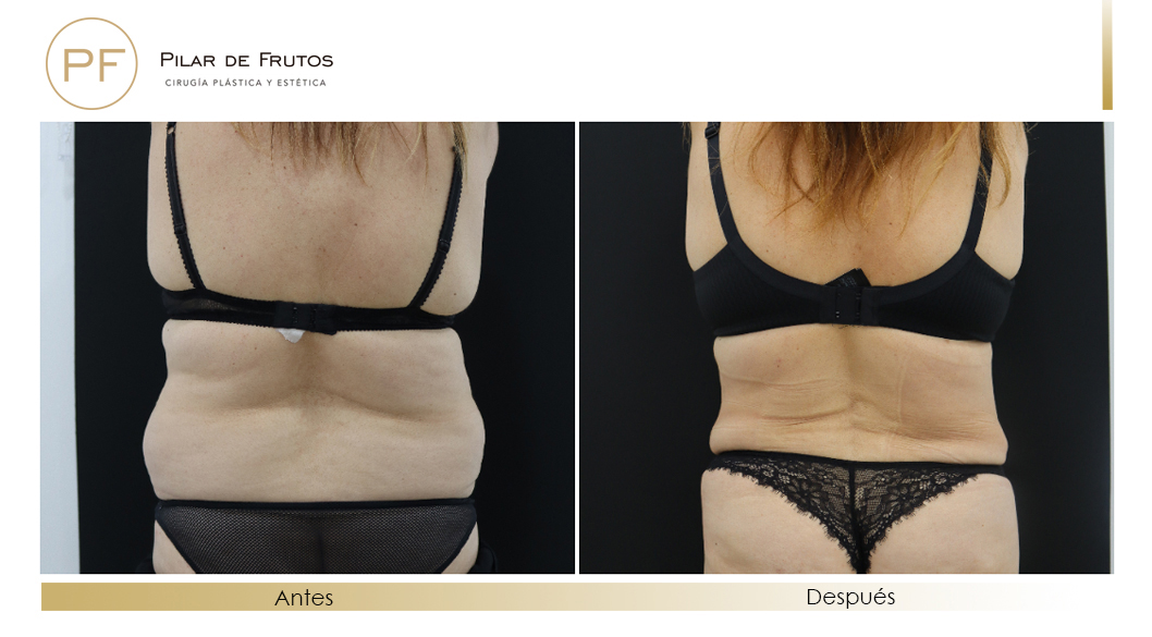 Body Tite Liposucción sin cirugía antes y después Body Tite Liposucción sin cirugía antes y después