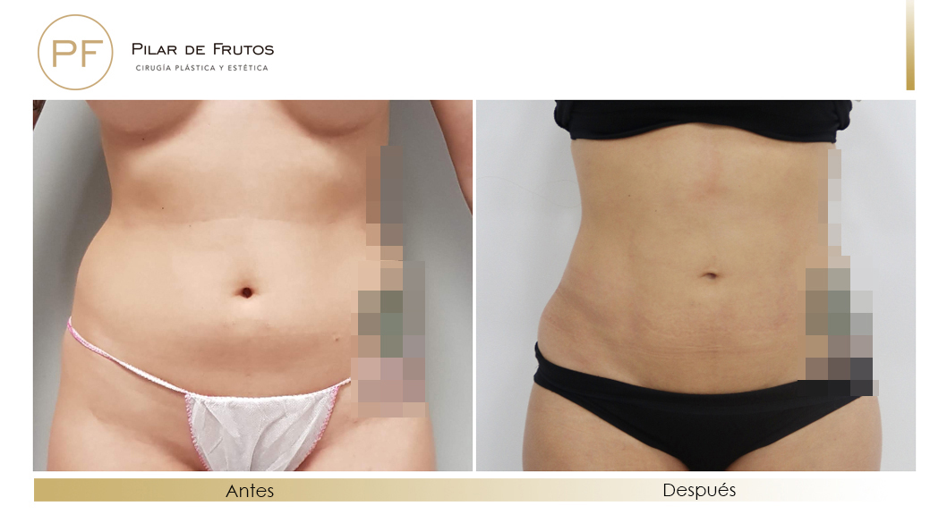 Body Tite Liposucción sin cirugía antes y después Body Tite Liposucción sin cirugía antes y después