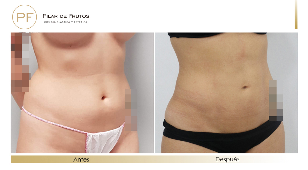 Body Tite Liposucción sin cirugía antes y después Body Tite Liposucción sin cirugía antes y después