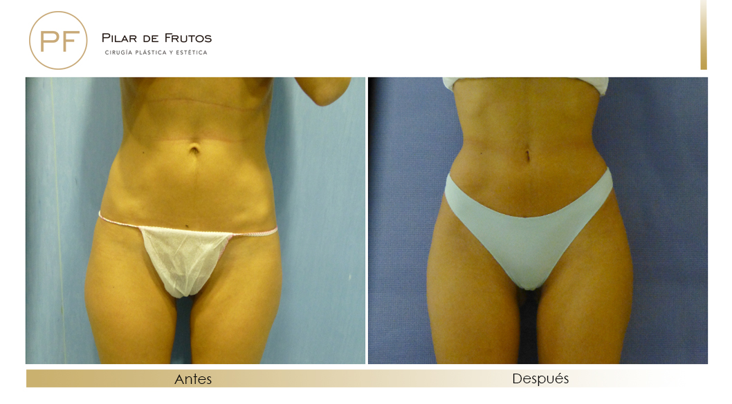 Body Tite Liposucción sin cirugía antes y después Body Tite Liposucción sin cirugía antes y después