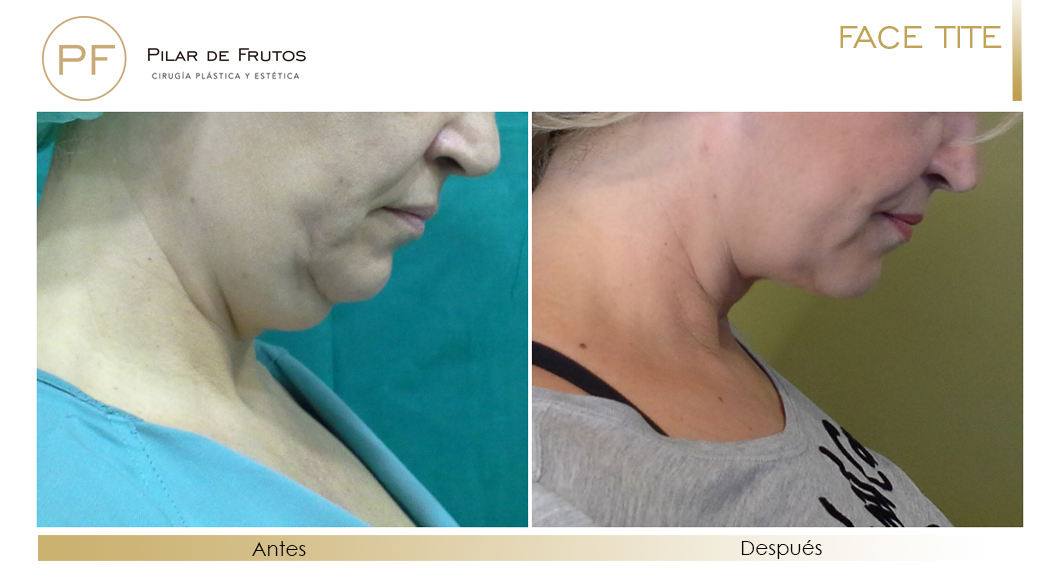 Papada: Fotos de antes y después Papada: Fotos de antes y después