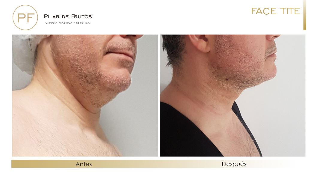 Papada: Fotos de antes y después Papada: Fotos de antes y después