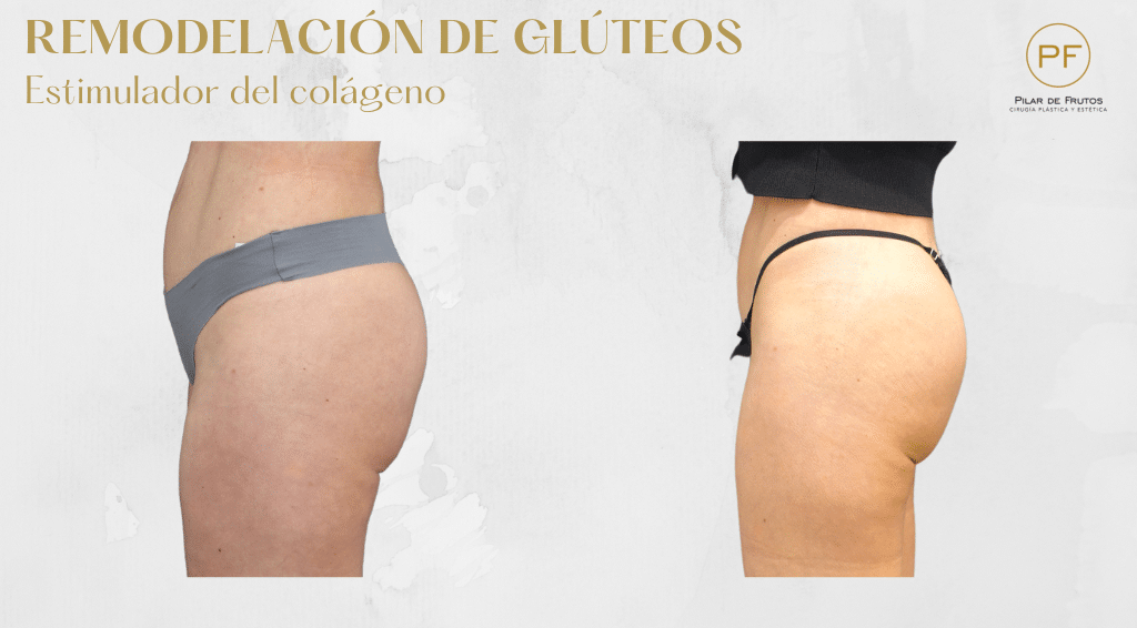 Fotos de Remodelacion de Glúteos Antes y Después Fotos de Remodelacion de Glúteos Antes y Después