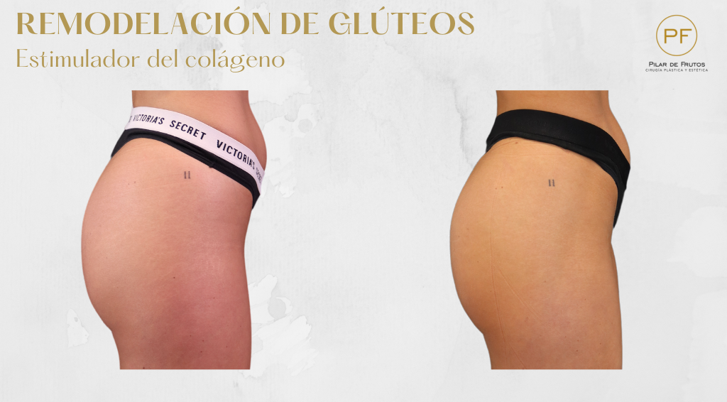 Fotos de Remodelacion de Glúteos Antes y Después Fotos de Remodelacion de Glúteos Antes y Después