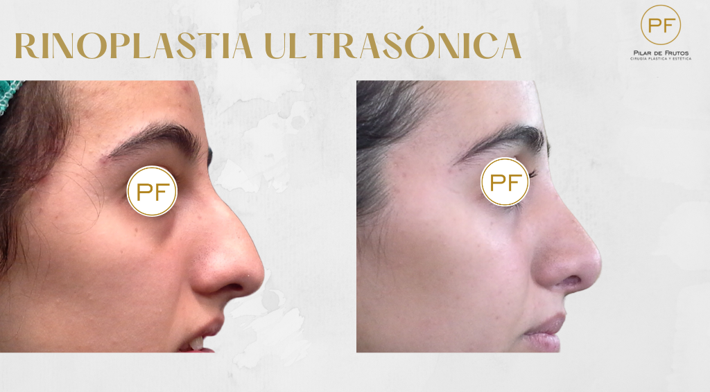 Fotos de Rinoplastia antes y después