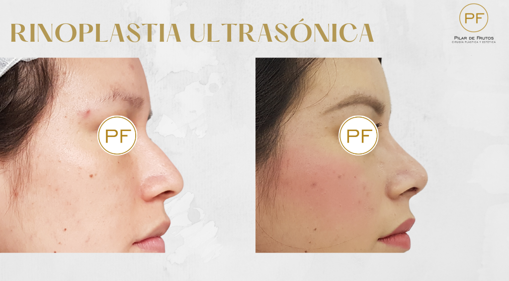 rinoplastia_ultrasónica_pilar_de_frutos_2 Fotos de Rinoplastia antes y después