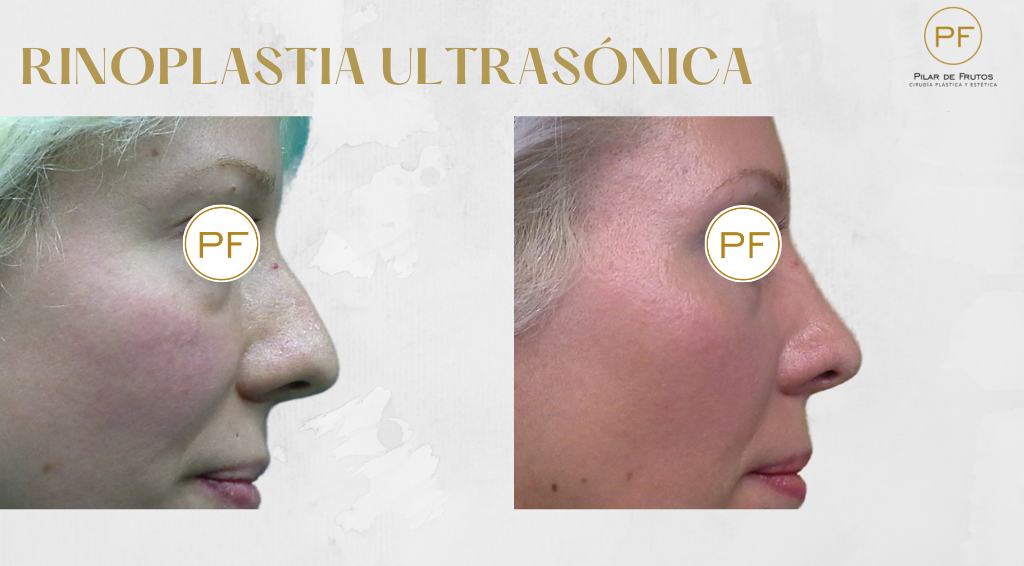 Fotos de Rinoplastia antes y después
