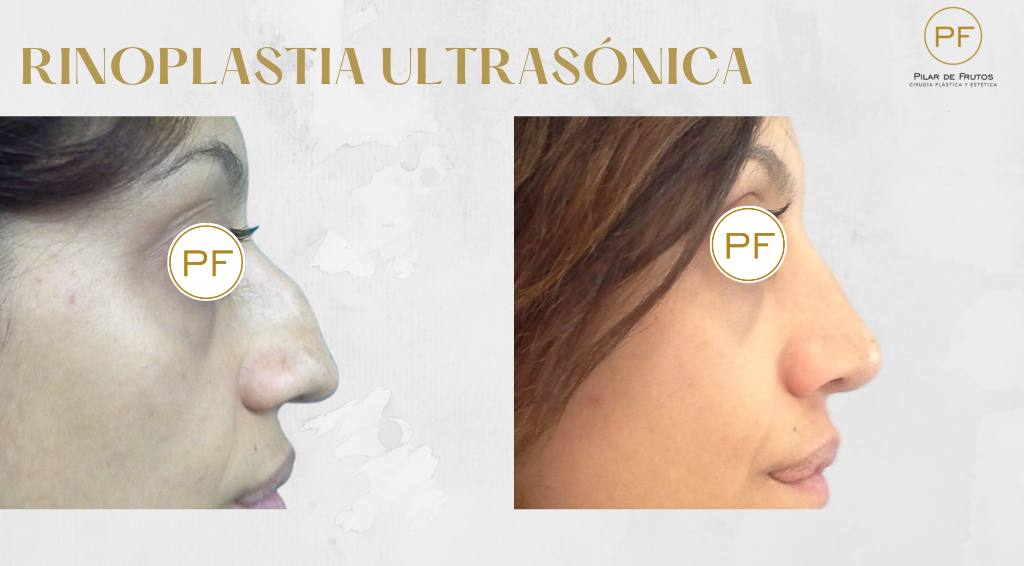 Fotos de Rinoplastia antes y después