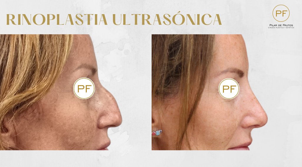 Fotos de Rinoplastia antes y después