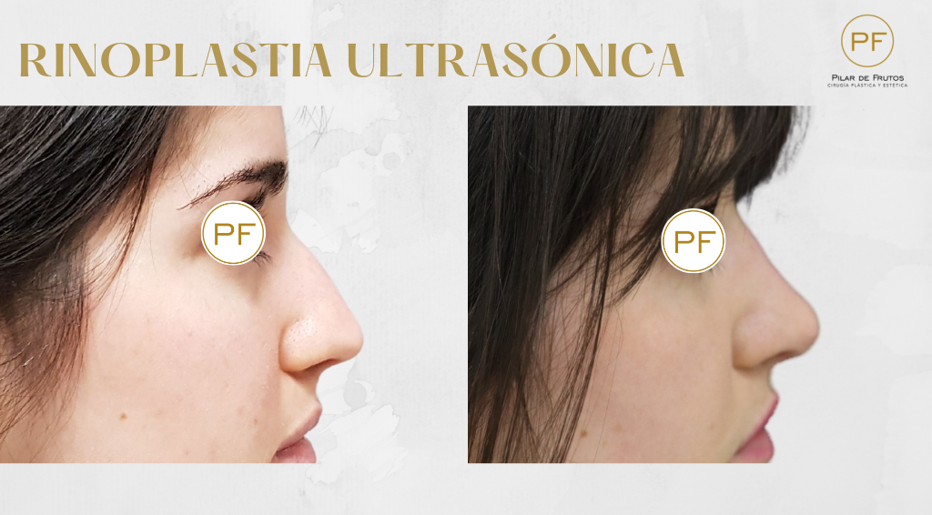Fotos de Rinoplastia antes y después Fotos de Rinoplastia antes y después