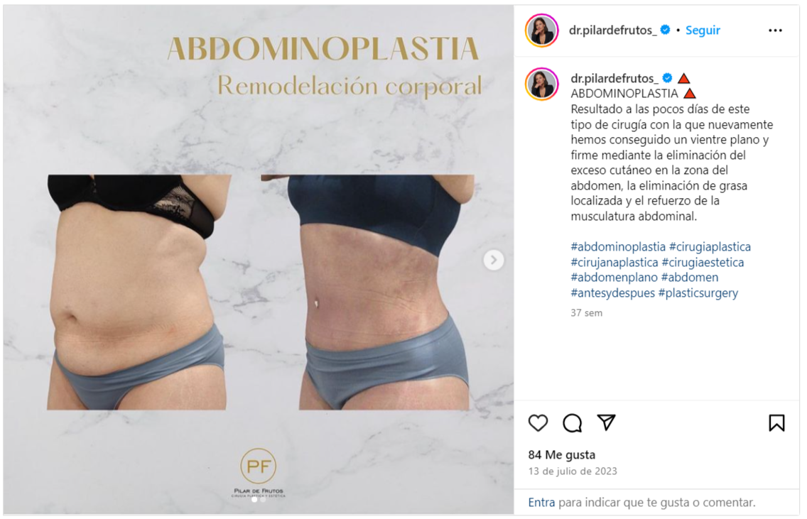 mini abdominoplastia