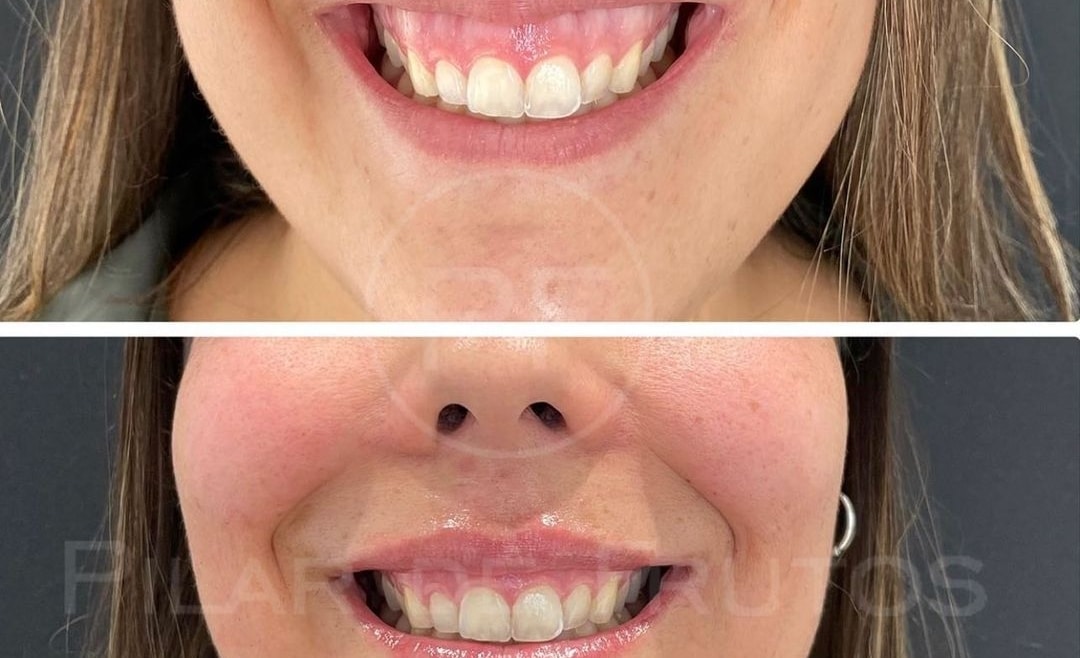 sonrisa gingival sonrisa gingival