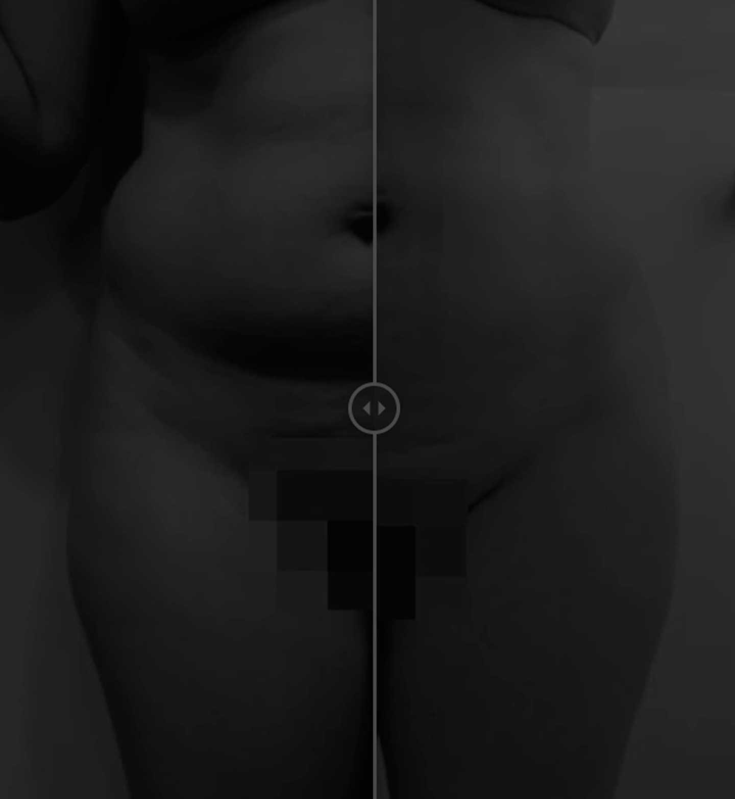 Body Tite, liposucción sin cirugía fotos de antes y después