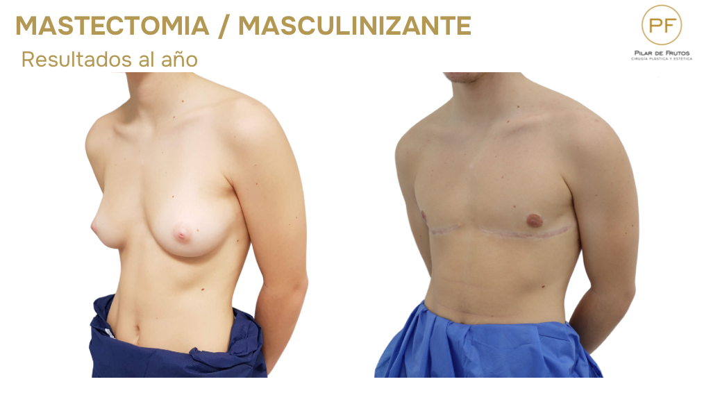 mastectomia trans masculinizante fotos antes y después mastectomia trans masculinizante fotos antes y después