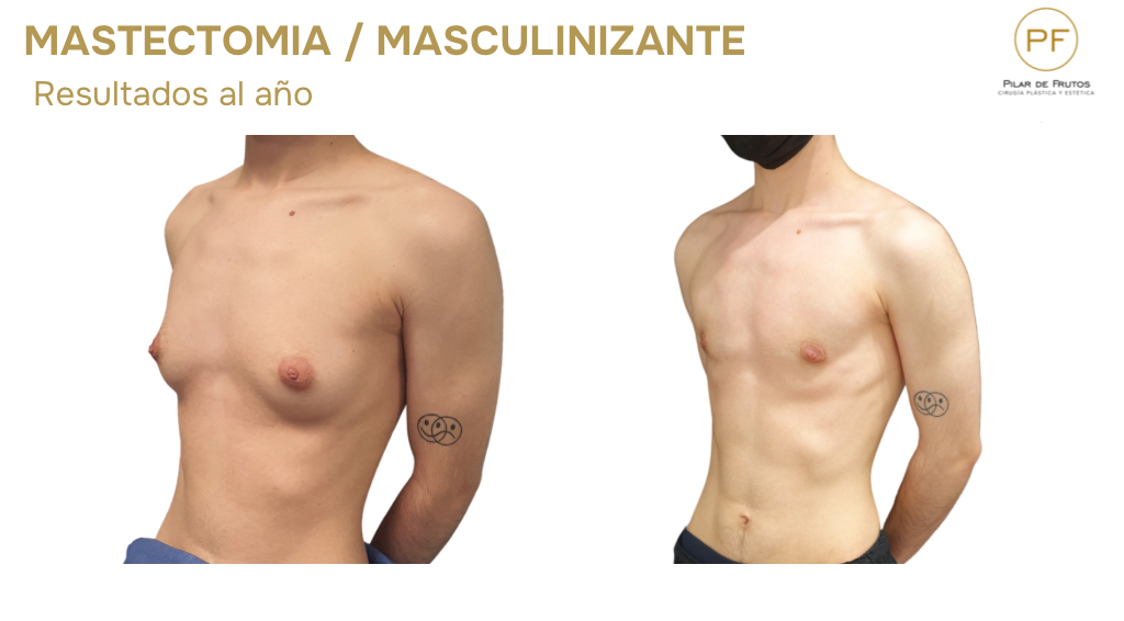 mastectomia trans masculinizante fotos antes y después mastectomia trans masculinizante fotos antes y después
