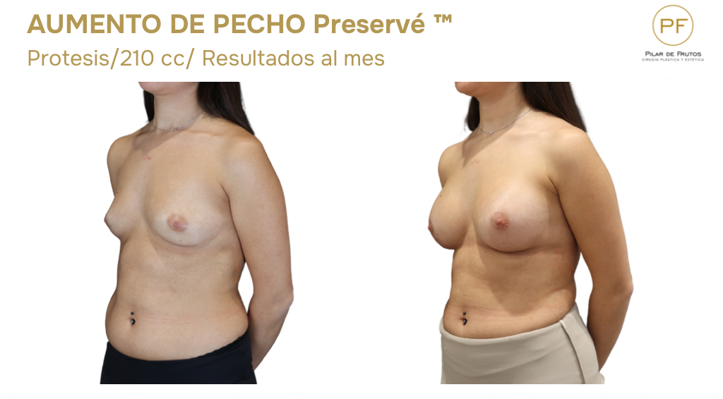 Preservé Aumento de pecho sin cirugia Preservé Aumento de pecho sin cirugia