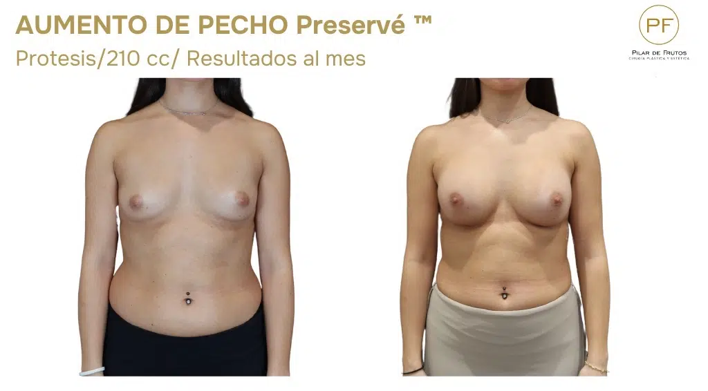 Preservé Aumento de pecho sin cirugia Preservé Aumento de pecho sin cirugia